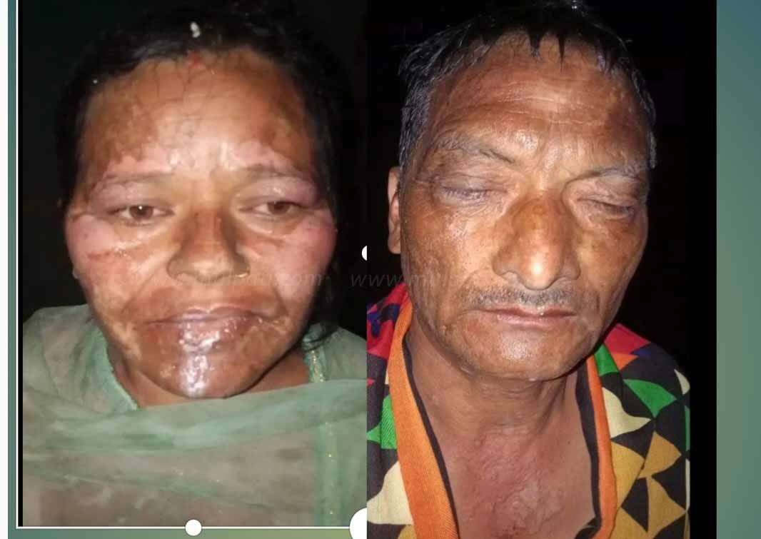 सल्यानमा भाइ र बुहारी माथी एसिड प्रहार