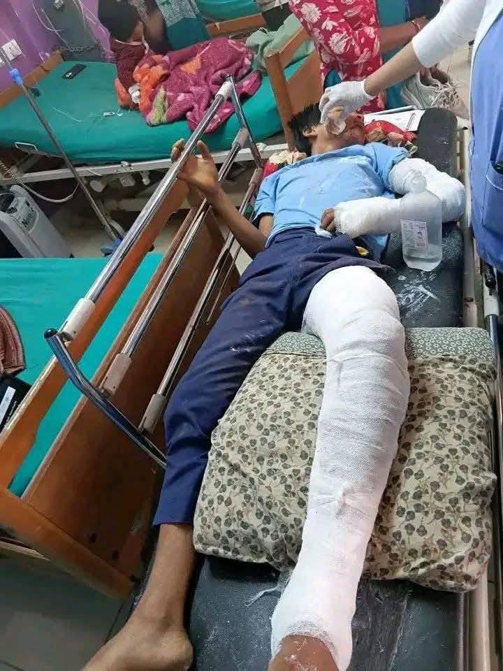 विद्यालयको छतबाट लडेर विद्यार्थीको हात र खुट्टा भाँचियो